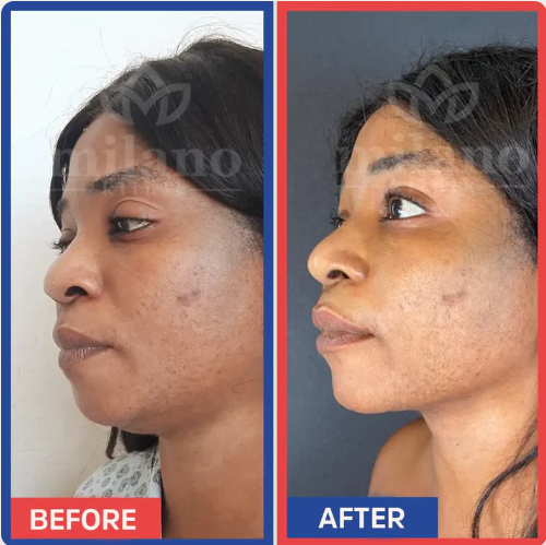 Bandage Amincissant Visage !