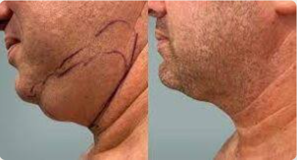 Bandage Amincissant Visage !