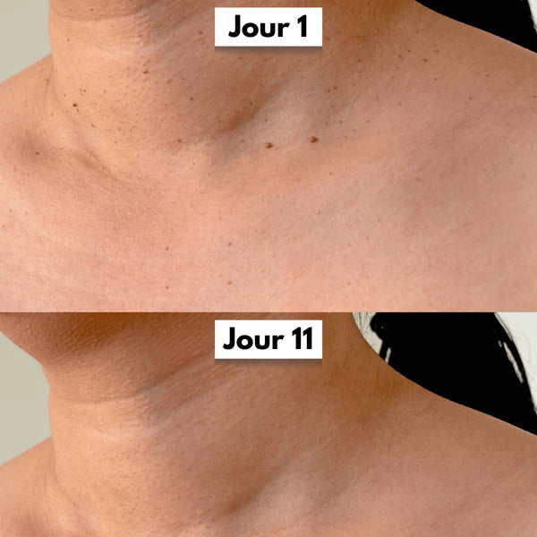 Kit DermaSkin Pro™ – Adieu Les Acrochordons, Résultat Immédiat BF
