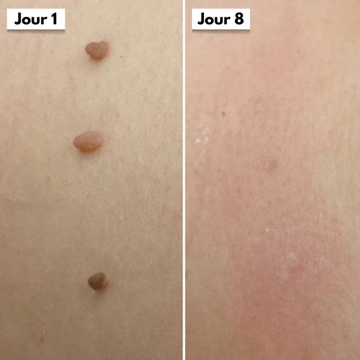 Kit DermaSkin Pro™ – Adieu Les Acrochordons, Résultat Immédiat BF