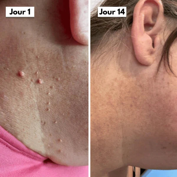 Kit DermaSkin Pro™ – Adieu Les Acrochordons, Résultat Immédiat BF